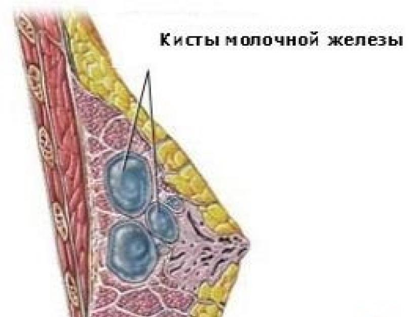 Маленький шарик возле соска. Самоосмотр молочной железы. Уплотнения в груди: методы диагностики.