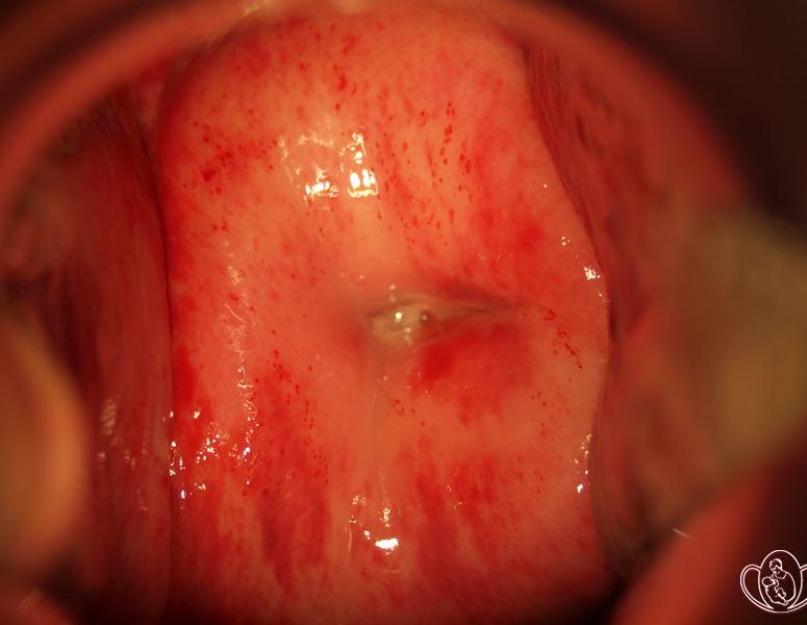 Endocervicite aiguë et chronique du col de l'utérus - causes et diagnostic, signes et traitement.  Endocervicite : symptômes et traitement Traitement de l'endocervicite cervicale