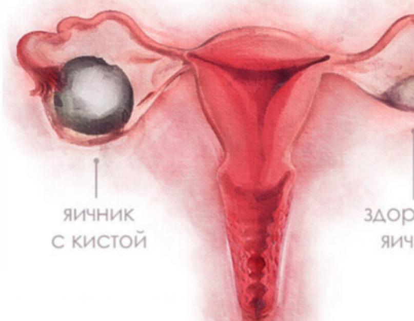 Yumurtalık kisti için ameliyat gerekli midir?  Yumurtalık kisti: Ameliyat için tehlikeli ve normal boyutlardadır.  Hangi doktor kisti çıkarmaya karar verir?