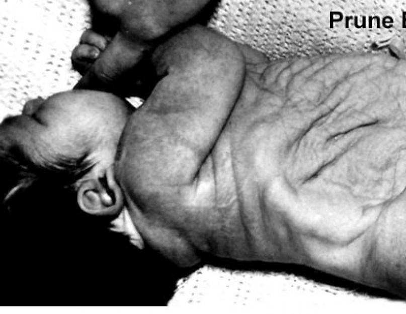 Bešika pritiska fetus.  Malformacije mokraćne bešike Povećanje zidova bešike fetusa na ultrazvuku