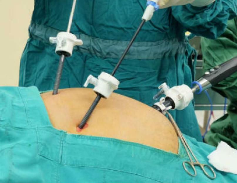 Какие методы обследования кишечника существуют кроме колоноскопии. Колоноскопия кишечника — подготовка к процедуре, отзывы и видео. Что лучше, УЗИ или колоноскопия