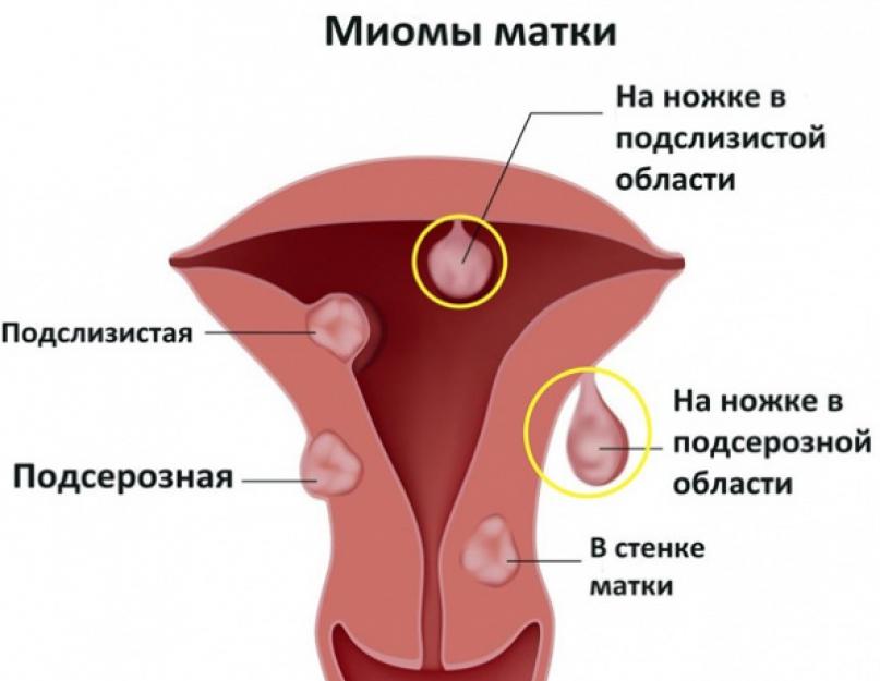 Is it necessary to remove fibroids after 40. What to do if uterine fibroids are found: is it always removed and what sizes are indications for surgery.  Indications for surgery