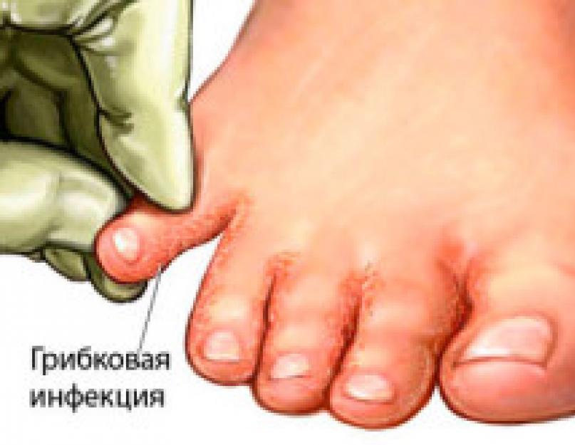 Pirštų mikozės gydymas liaudies gynimo priemonėmis greitai Pirštų mikozės gydymas liaudies gynimo priemonėmis greitai